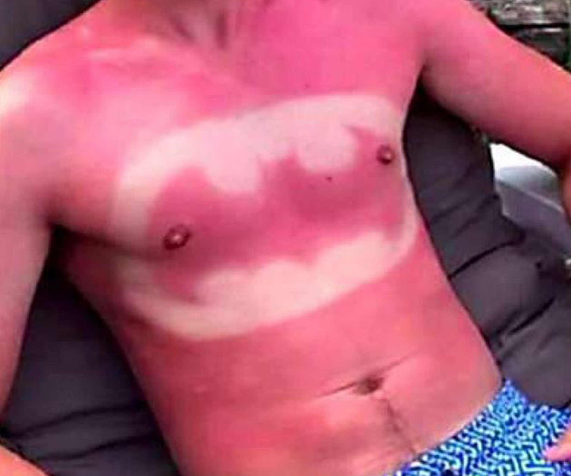 Sunburn art has become a trend