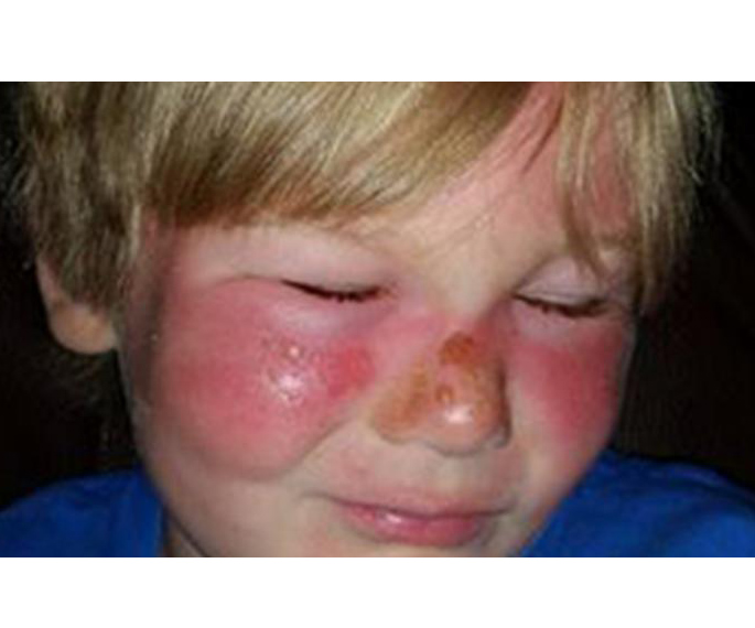 Boy suffers second degree burns after applying popular 50SPF sunscreen