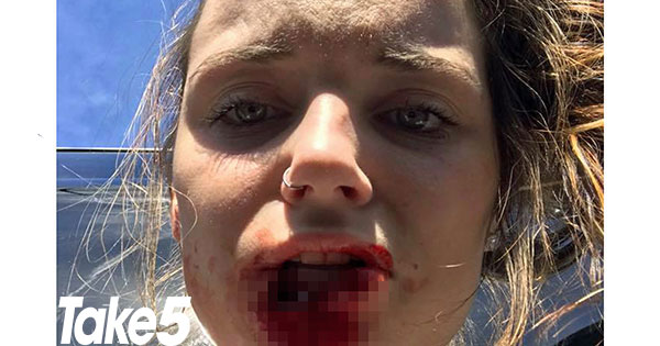 Real life: My abusive ex-boyfriend bit off my lip in a fit of rage