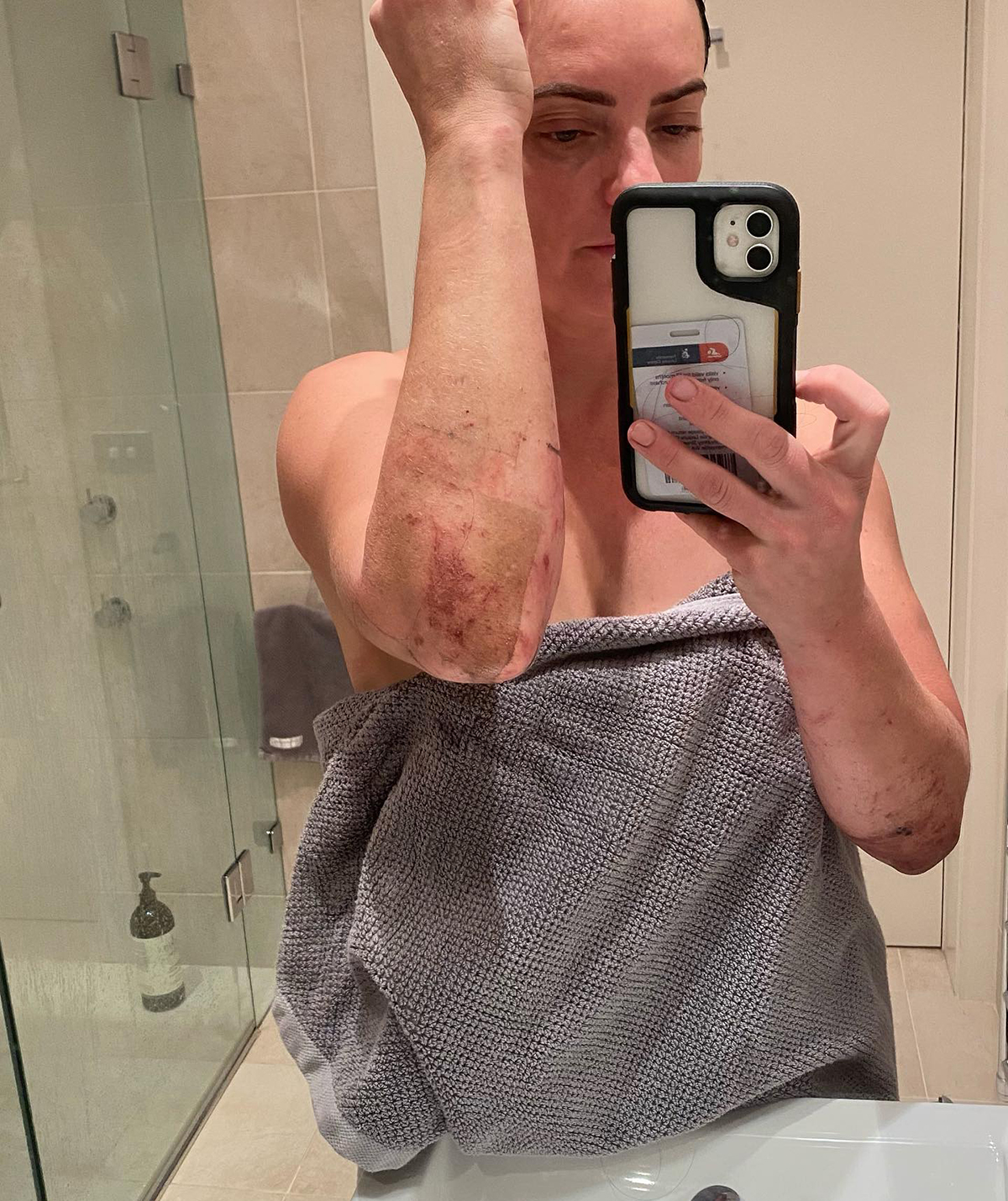 SAS Australia's Simone Holtznagel shows off bruises after show